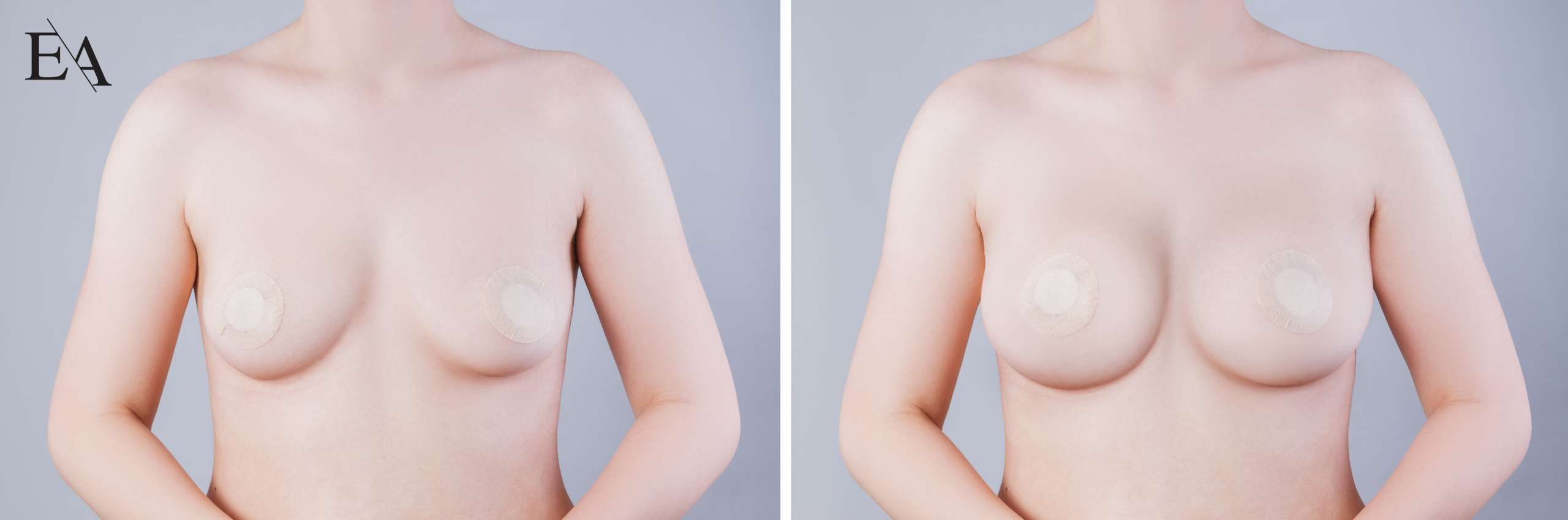 Meme Rekonstrüksiyonu