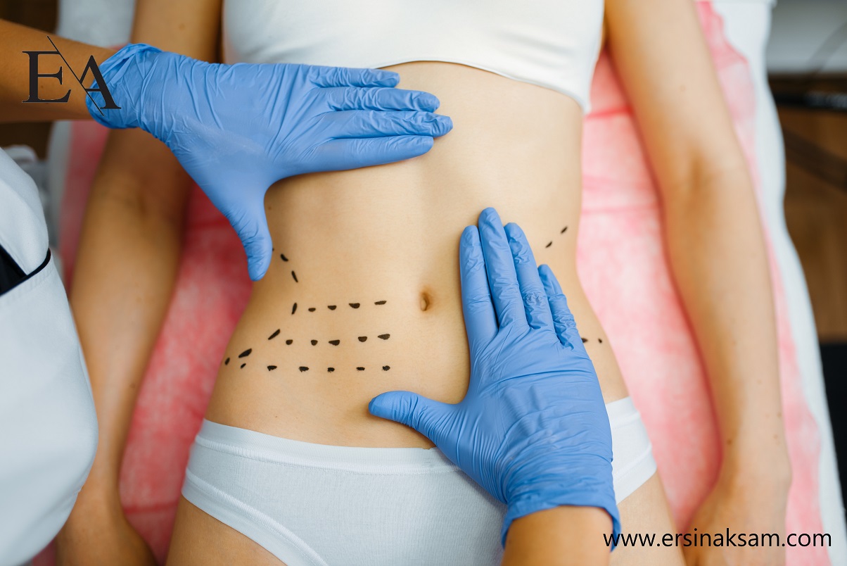 Vaser Liposuction